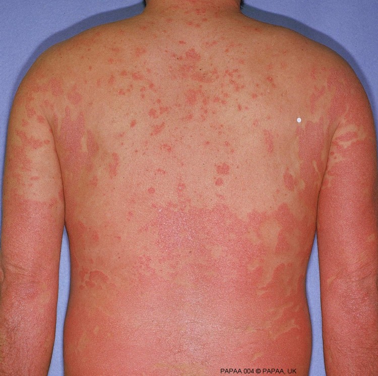 Widespread erythrodermic on back.jpg