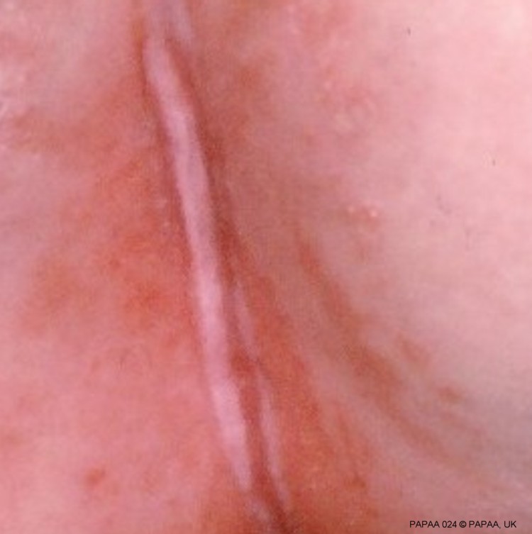 Flexure or inverse psoriasis.jpg