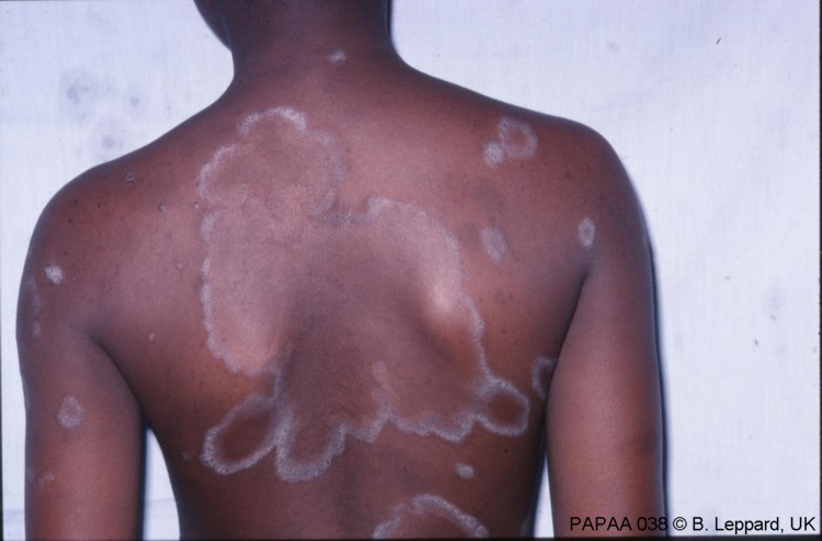Plaque psoriasis on upper back.jpg