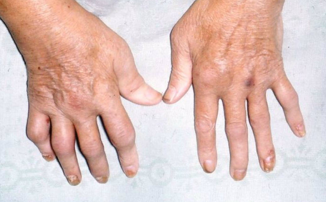Symmetrical rheumatoid arthritis-like picture.jpg