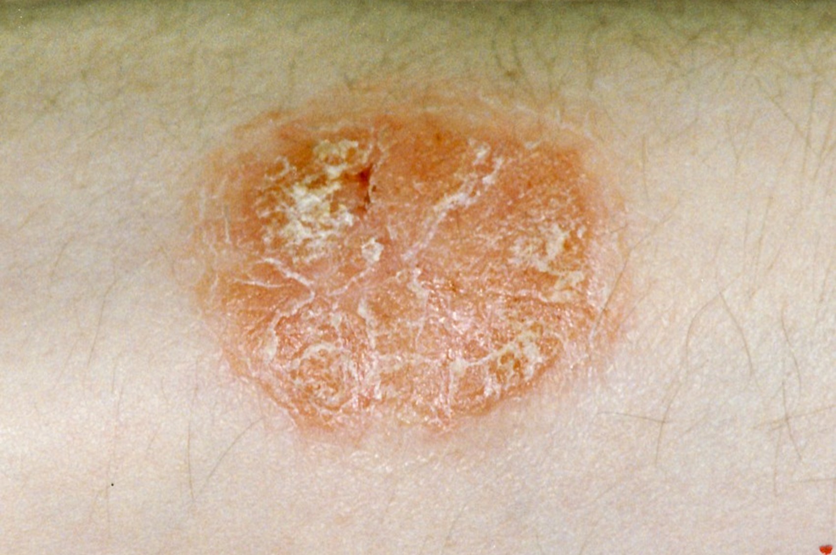 Psoriasis plaque 1.jpg