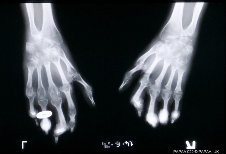 Psoriatic arthritis xray 2.jpg