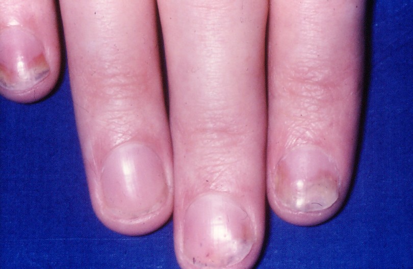 Nail psoriasis