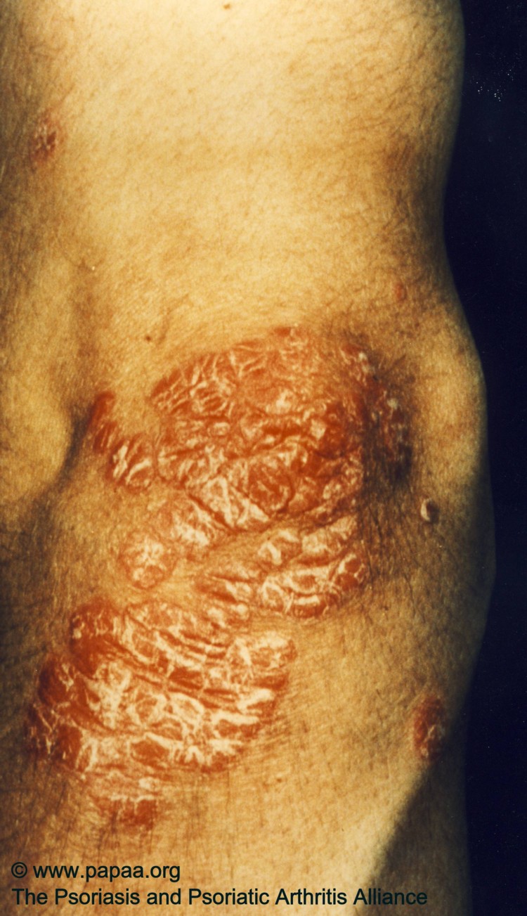 Plaque psoriasis on elbow.jpg