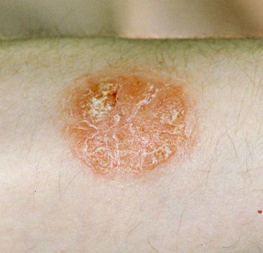 Psoriasis plaque 1.jpg