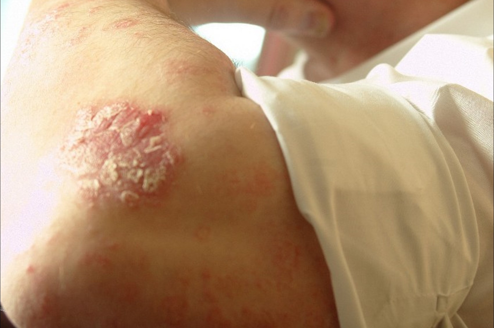 Psoriasis on elbow.jpg