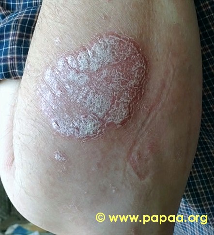 Plaque Psoriasis On Forearm