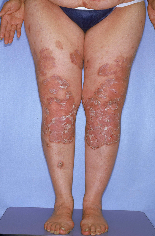 Psoriaisis On Front Of Legs 3