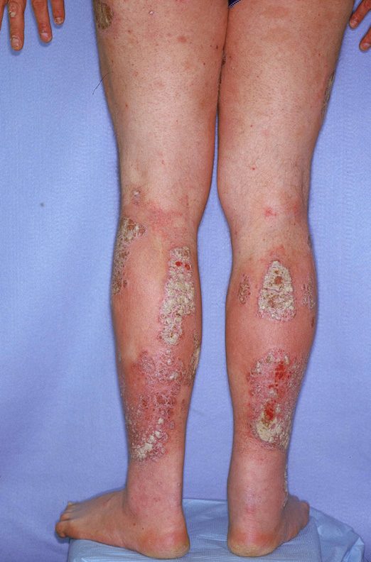 Psoriaisis On Legs 1