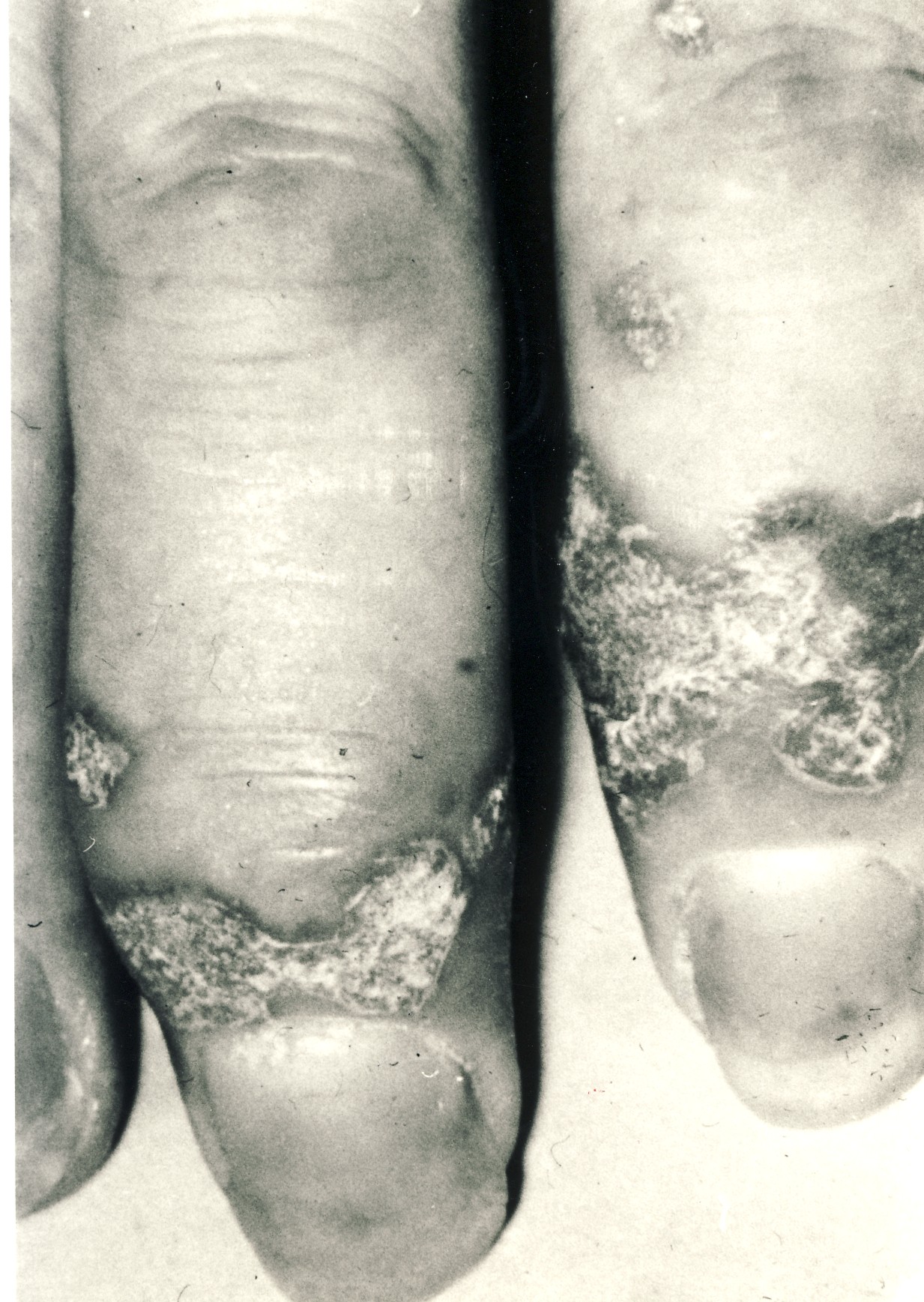 Psoriasis And Psoriatic Arthritis On Hand Black White Image
