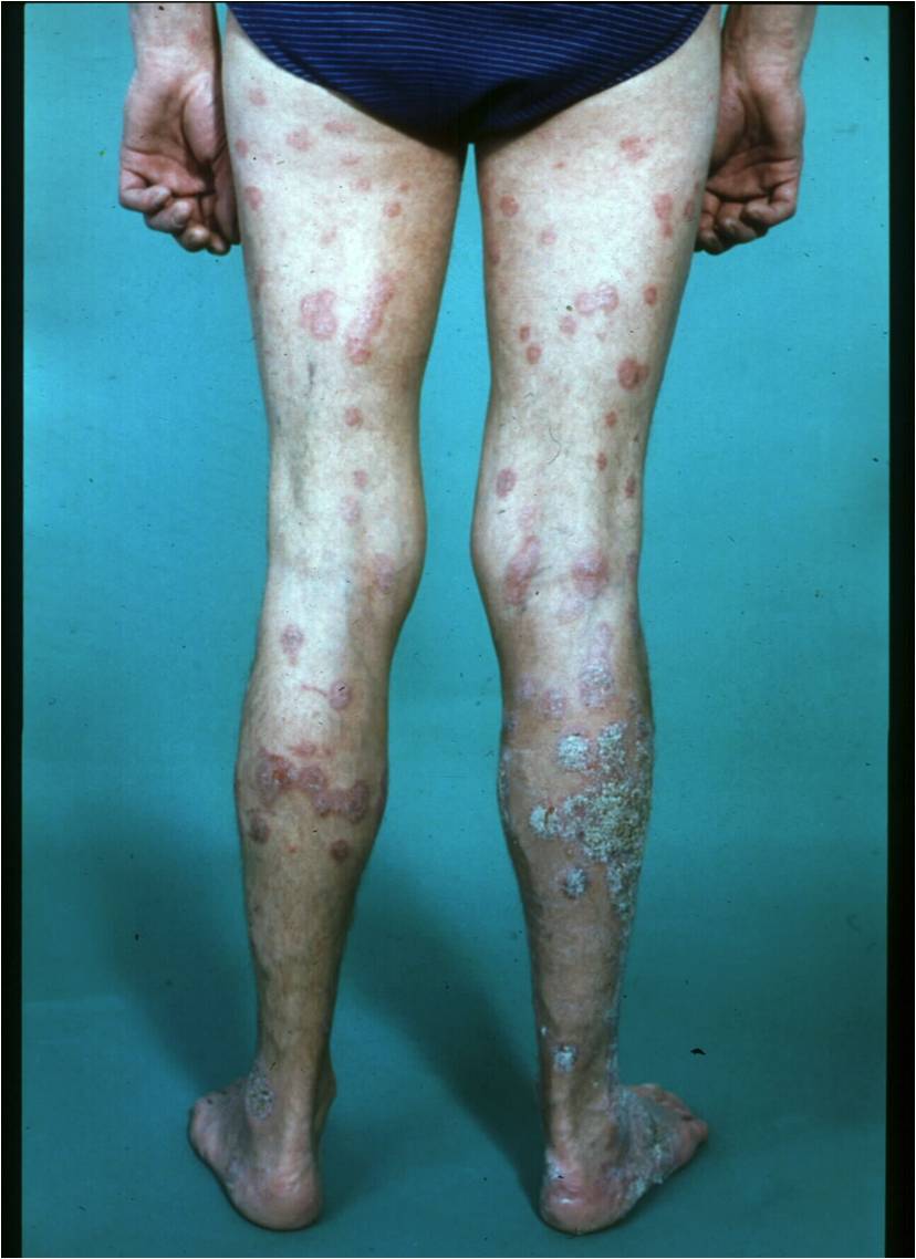 Psoriasis On Legs