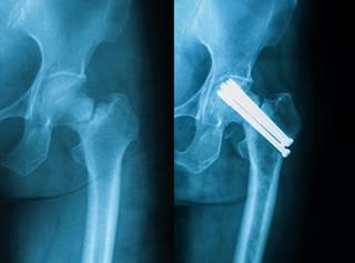 Hip Pinning