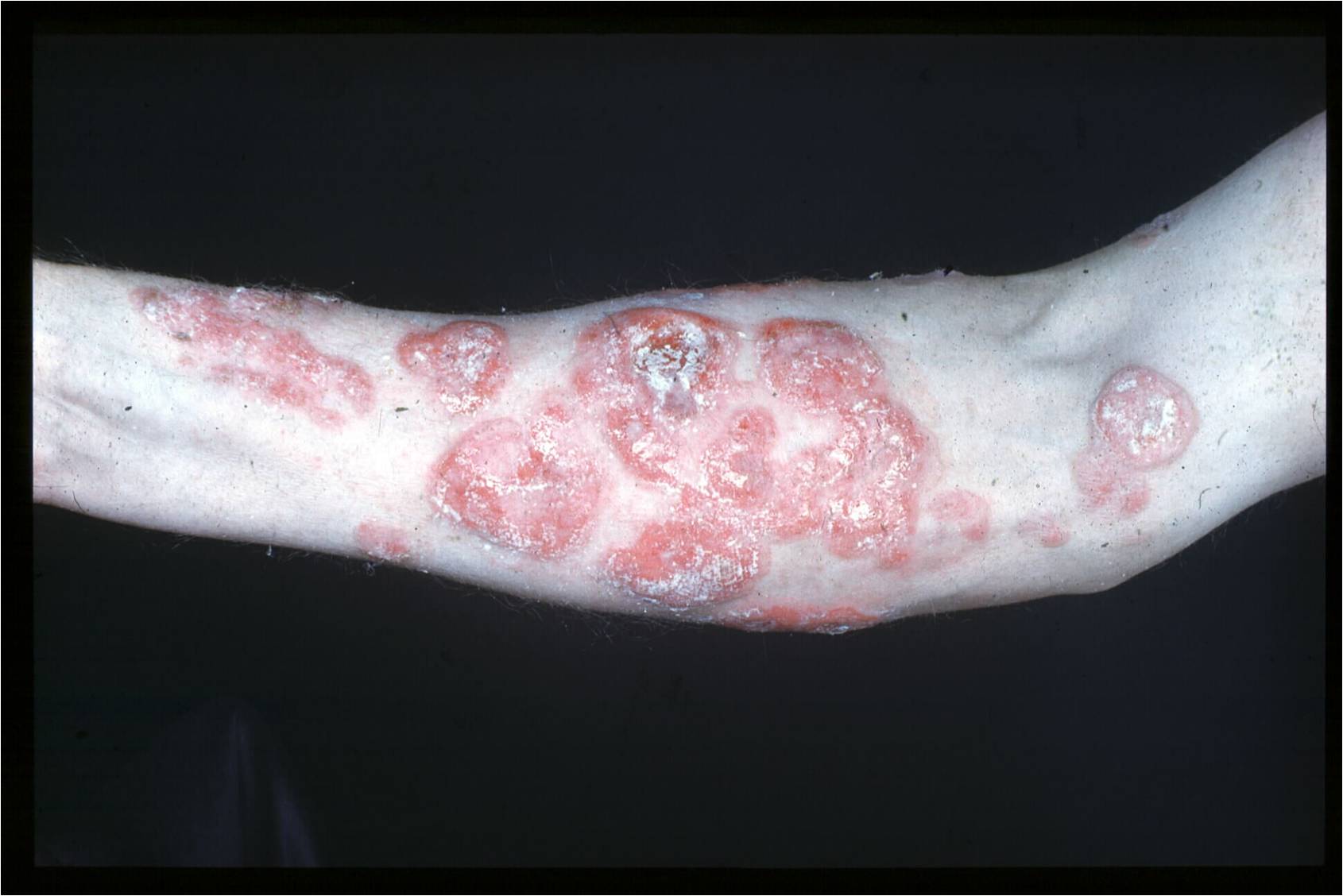 Mycosis Fungoides
