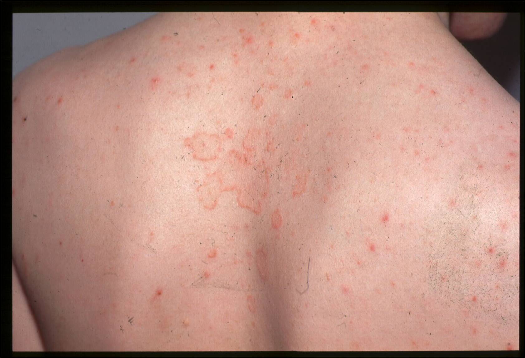 Seborrhoeic Dermatitis