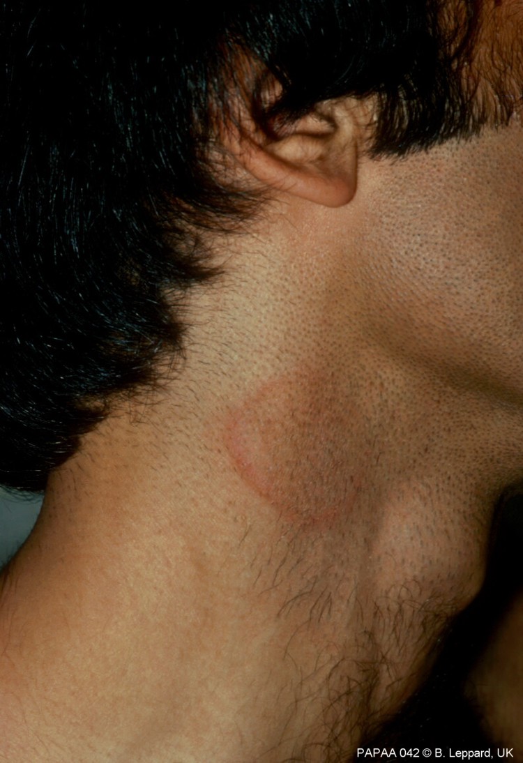 Tinea Corpia