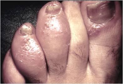 Dactylitis