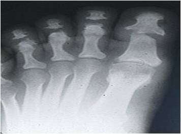 Osteolysis