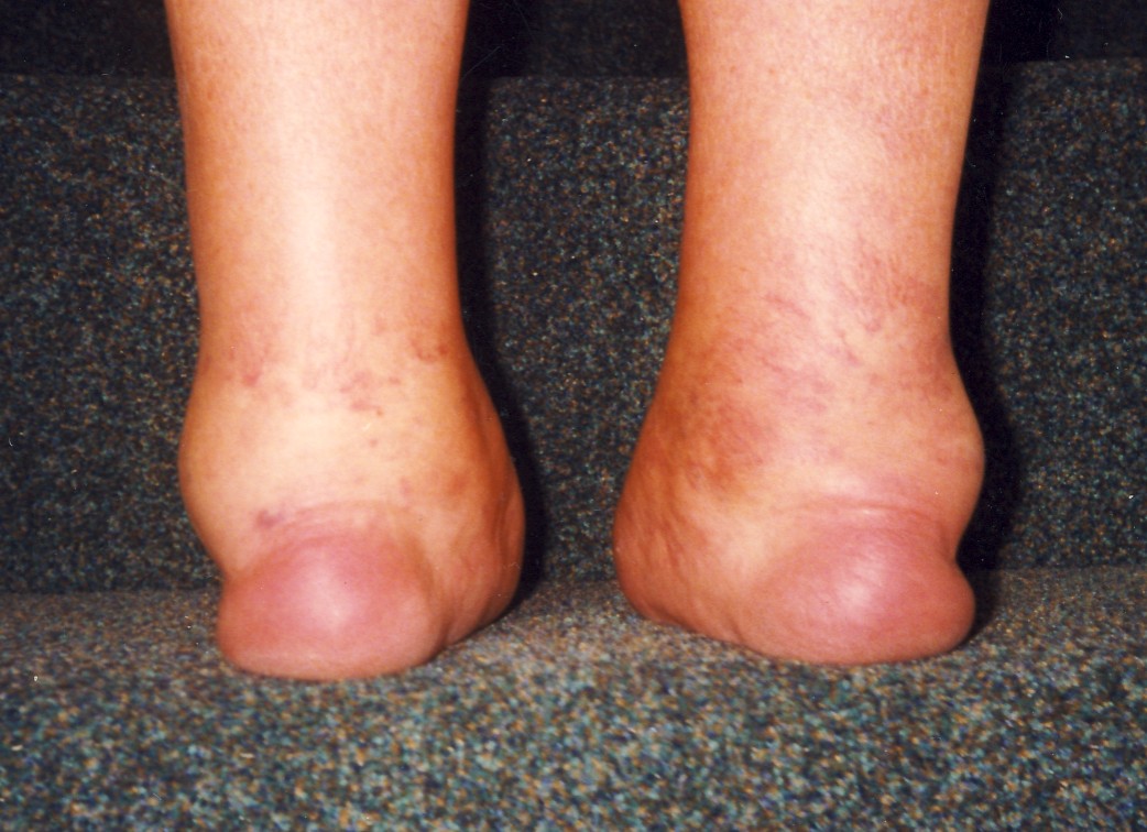 Psoriatic Arthritis Feet And Ankles Rear View