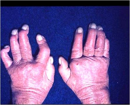 Psoriatic Arthritis