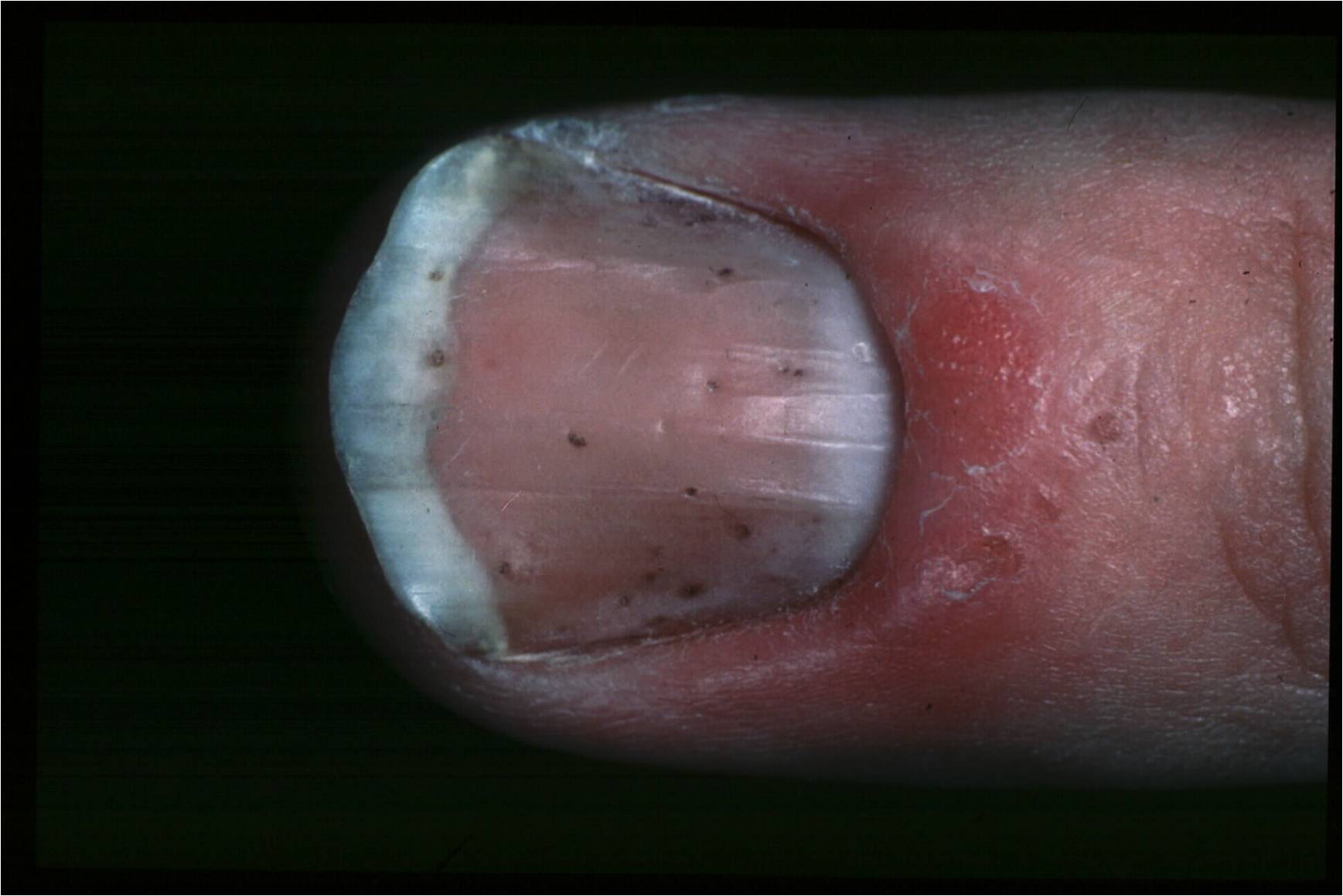 Nail Psoriasis 1