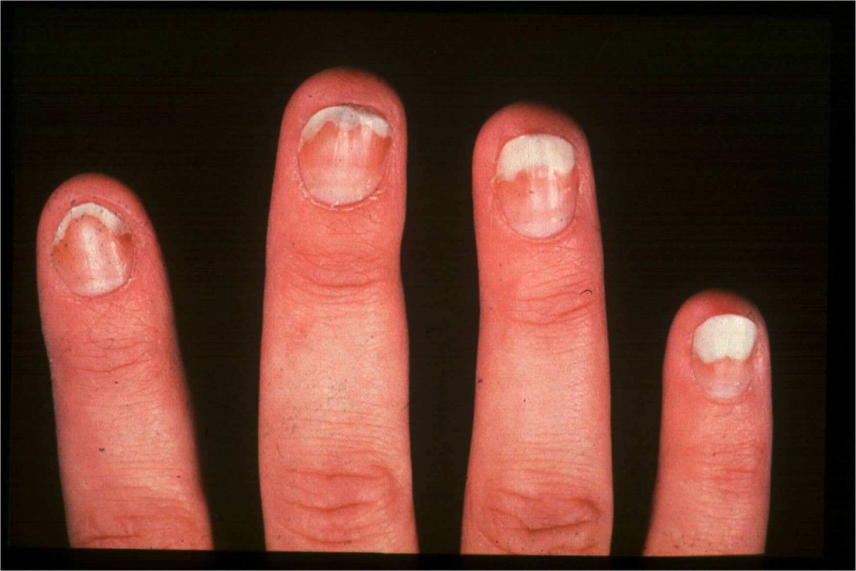 Nail Psoriasis