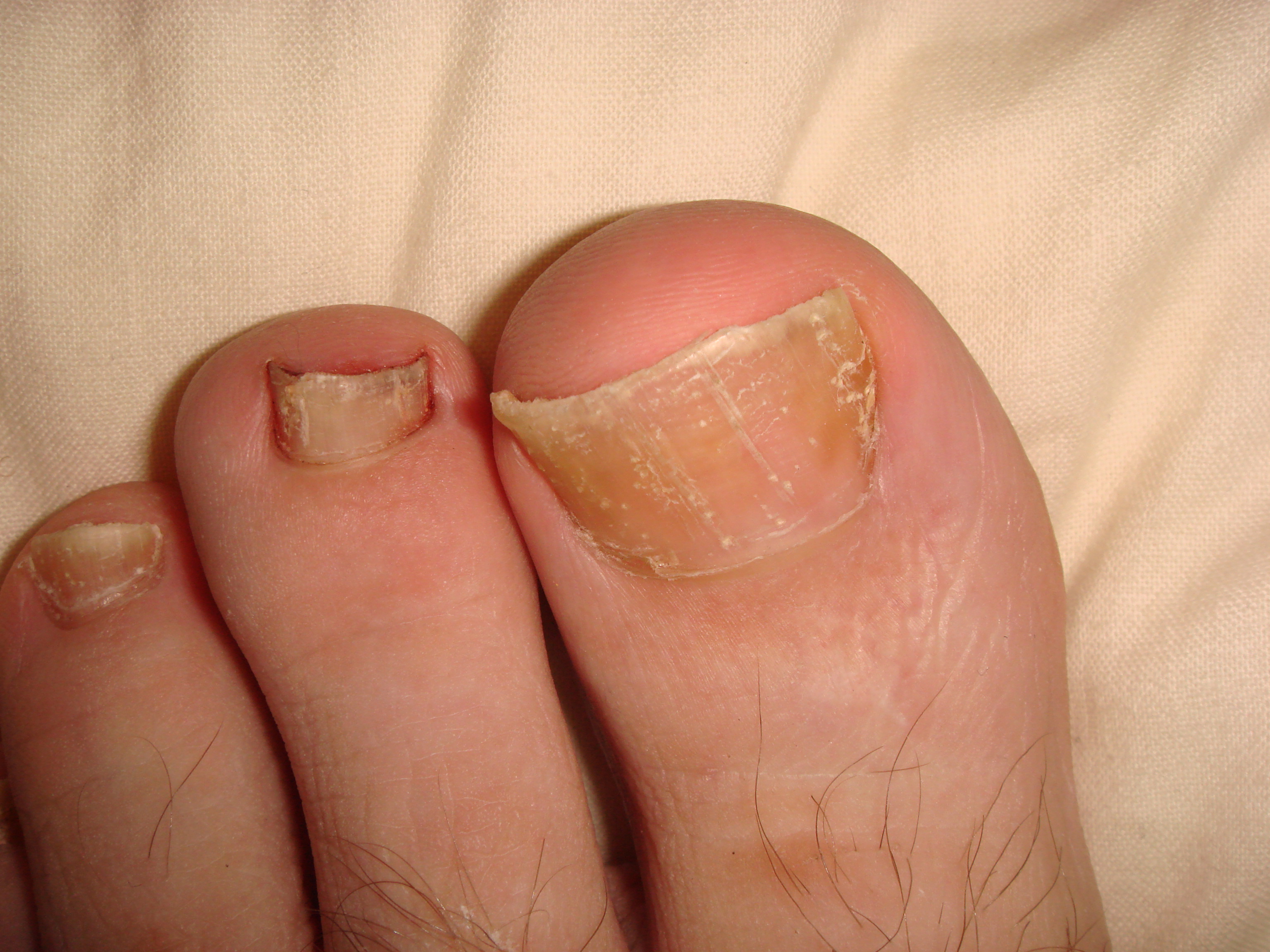 Psoriasis On Toe Nails