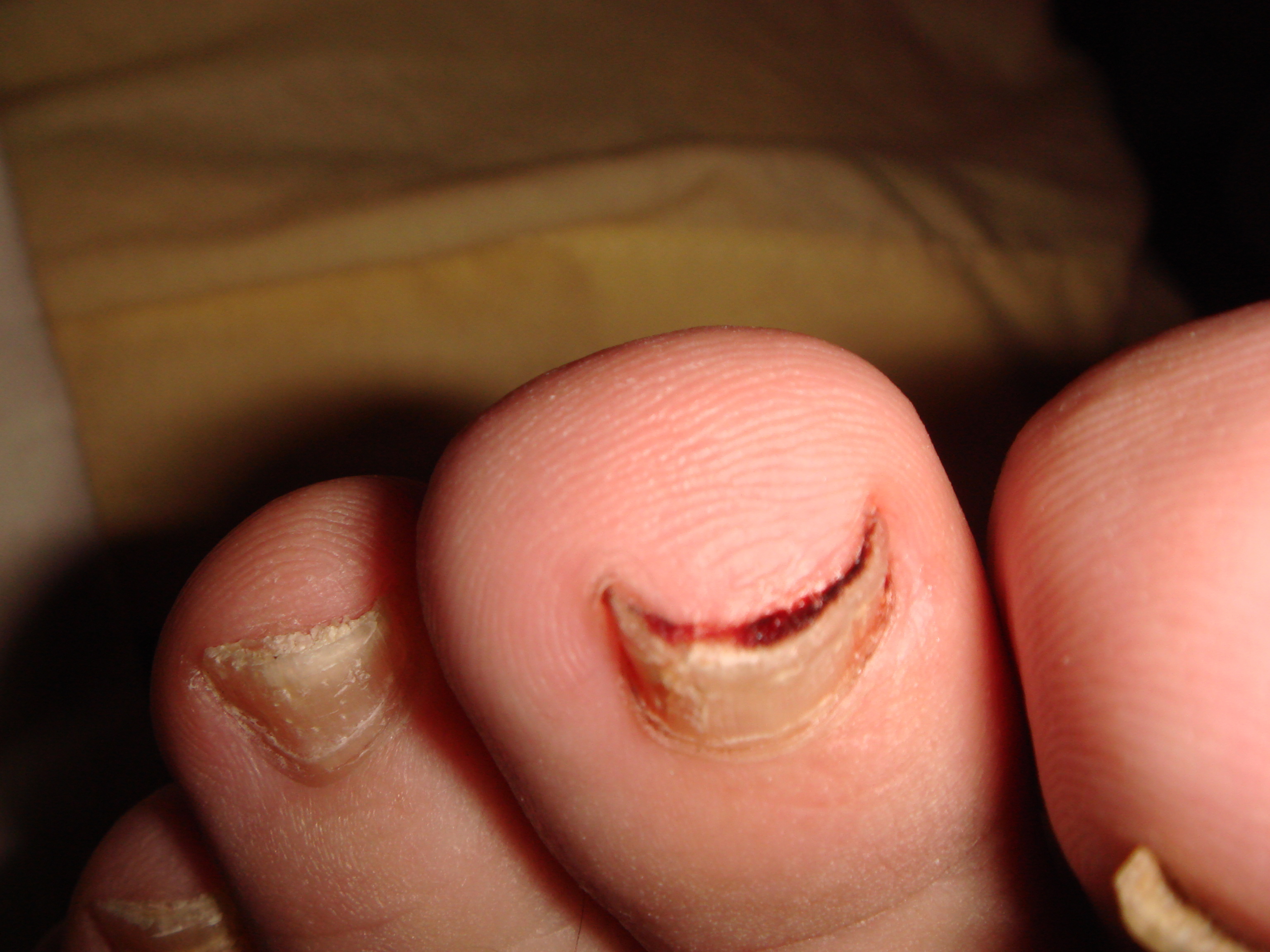 Toe Nails With Psoriasis