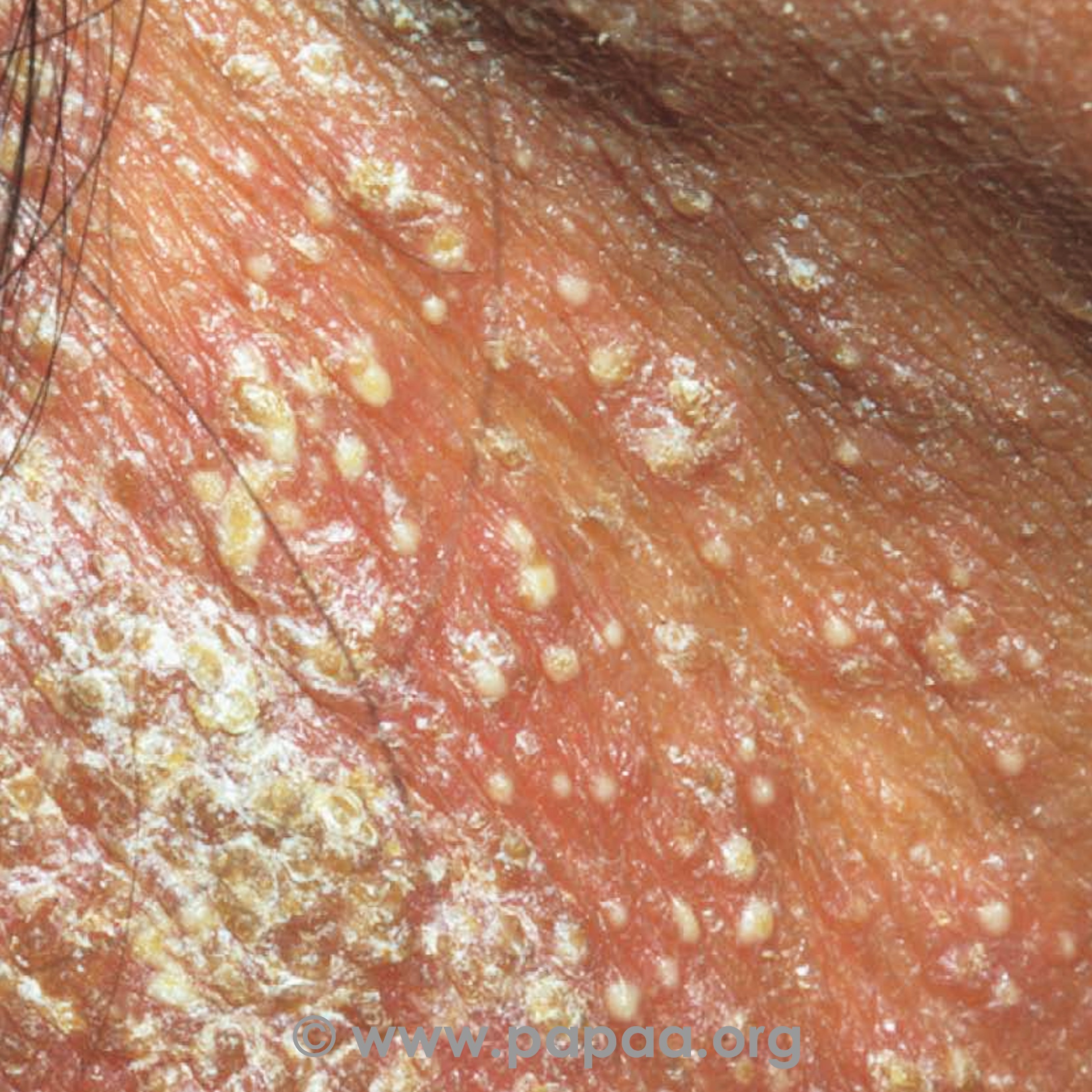 Generalised pustular psoriasis