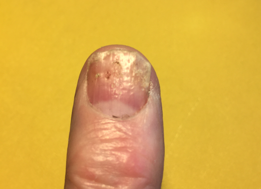 Nail Psoriasis