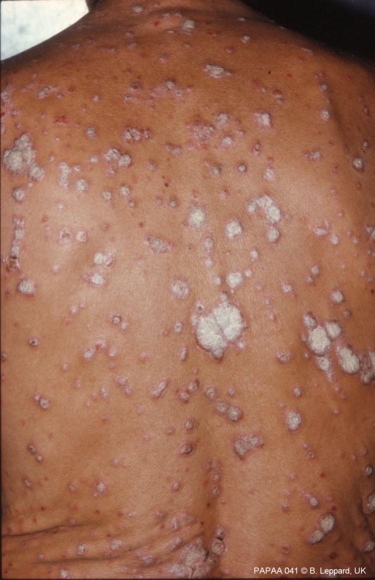 Plaque psoriasis on back.jpg