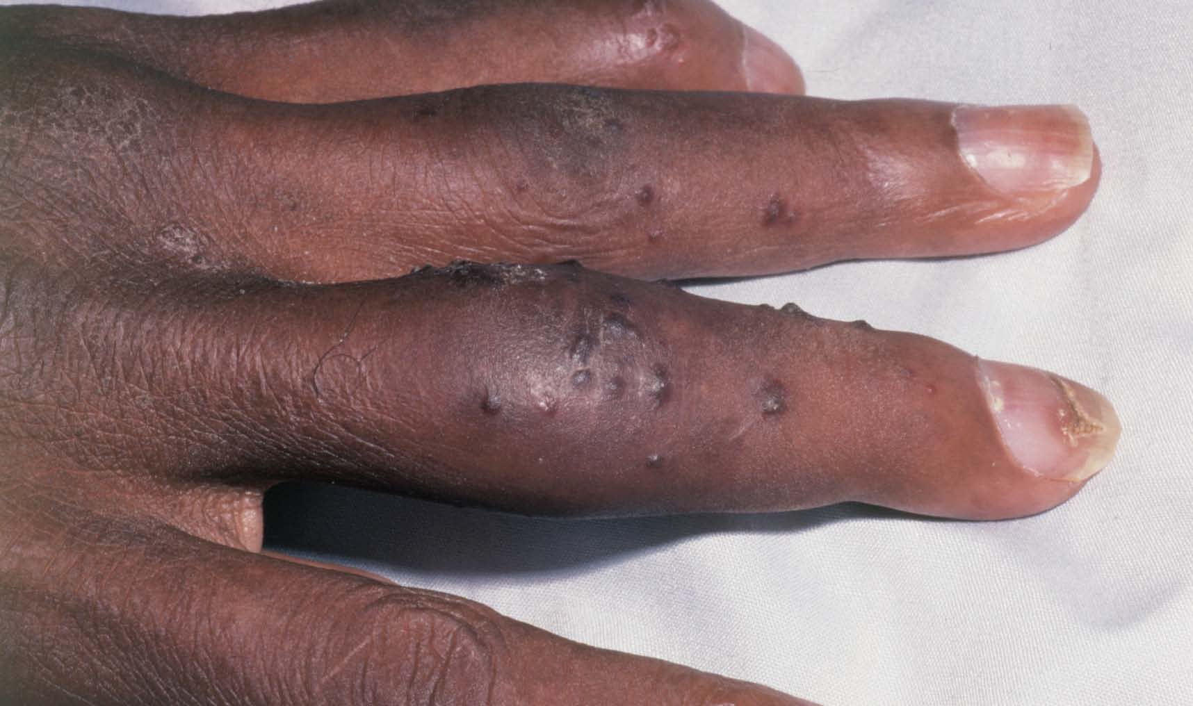 Psoriatic arthritis hiv infection.jpg