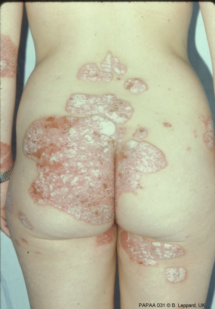 Plaque psoriasis on buttocks.jpg