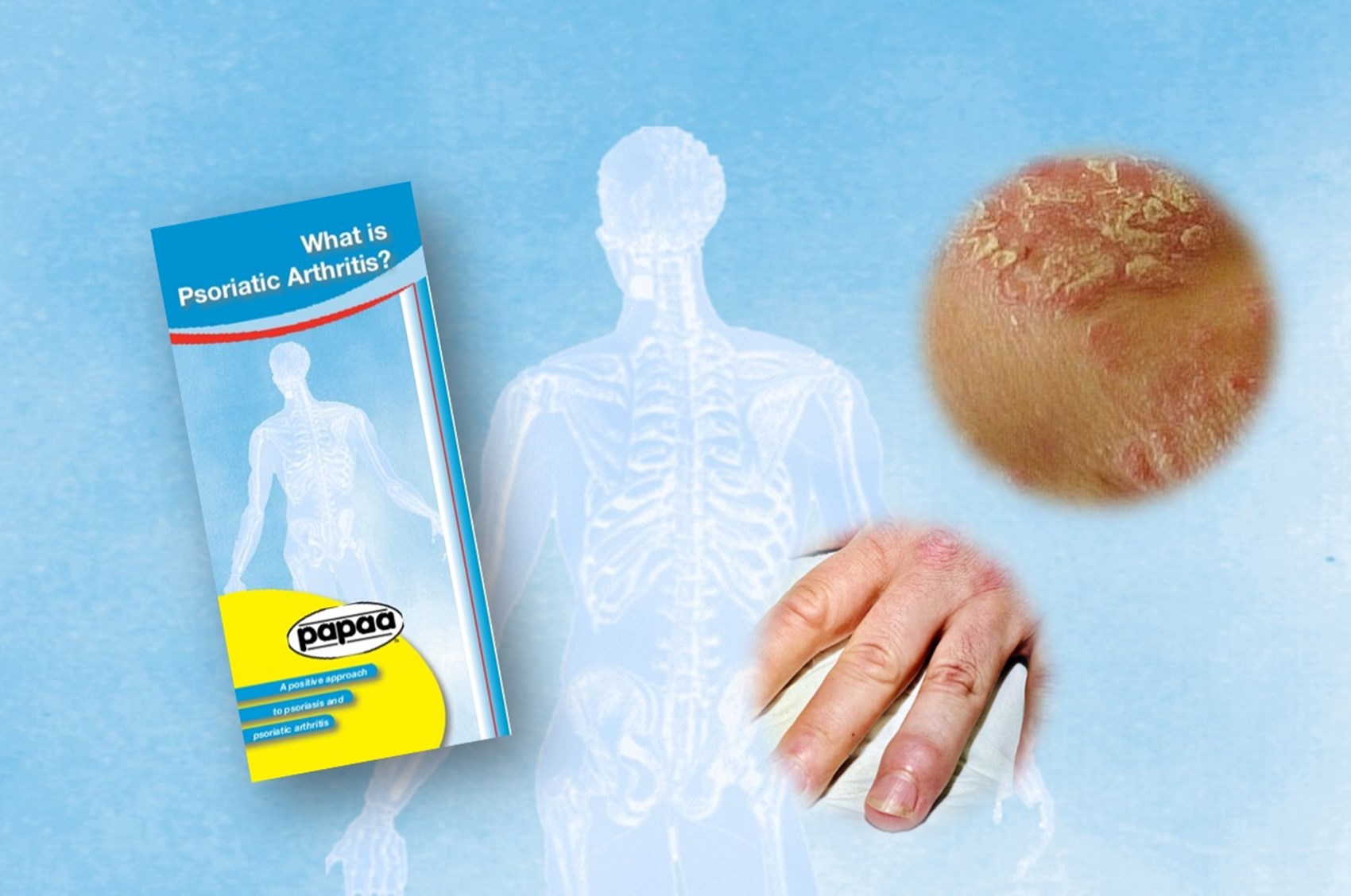 Learn All About Psoriatic Arthritis