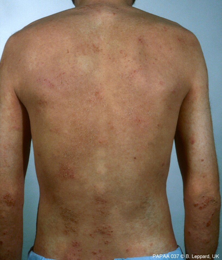 Plaque psoriasis on back male.jpg