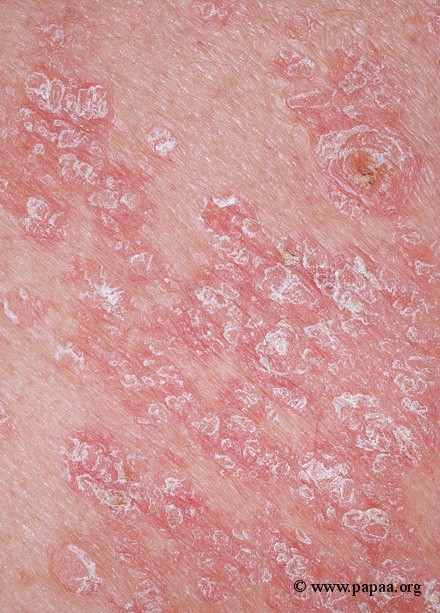 Close up of psoriasis.jpg