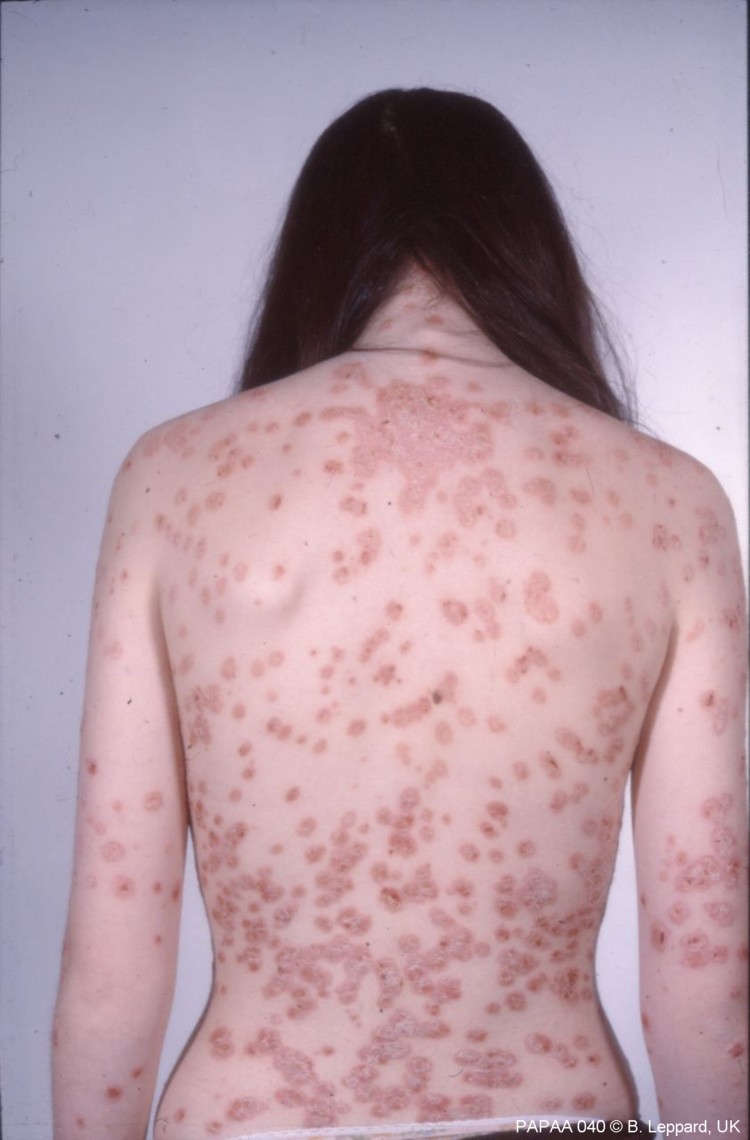 Plaque psoriasis on female back.jpg