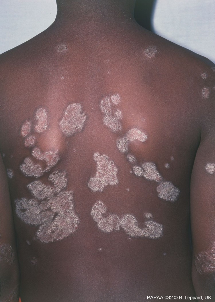 Plaque psoriasis on trunk.jpg