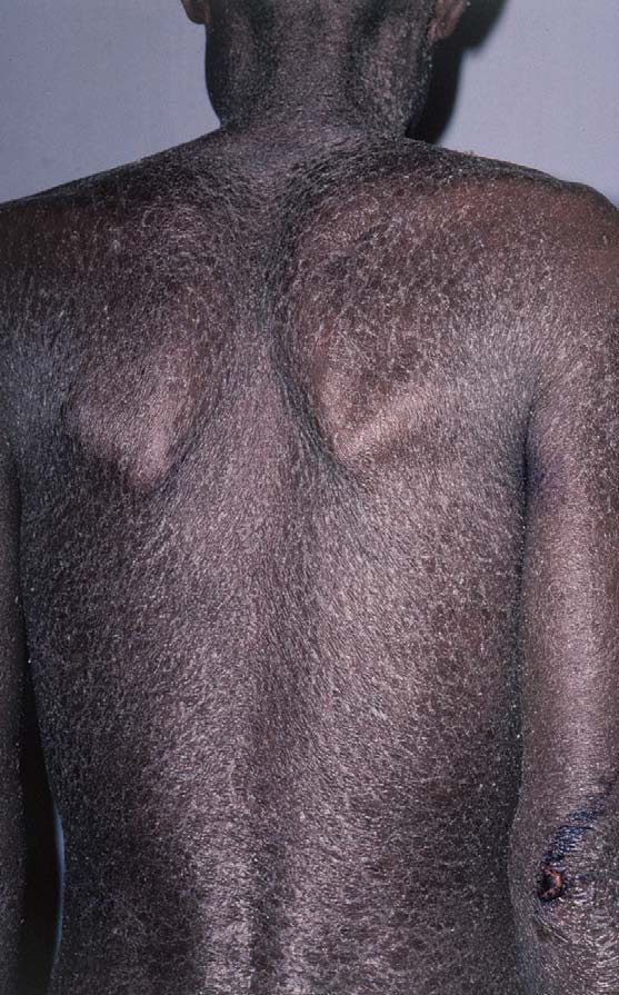 Erythrodermic psoriasis on back widespread.jpg