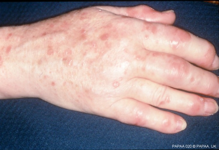 Psoriatic arthritis hands 4.jpg