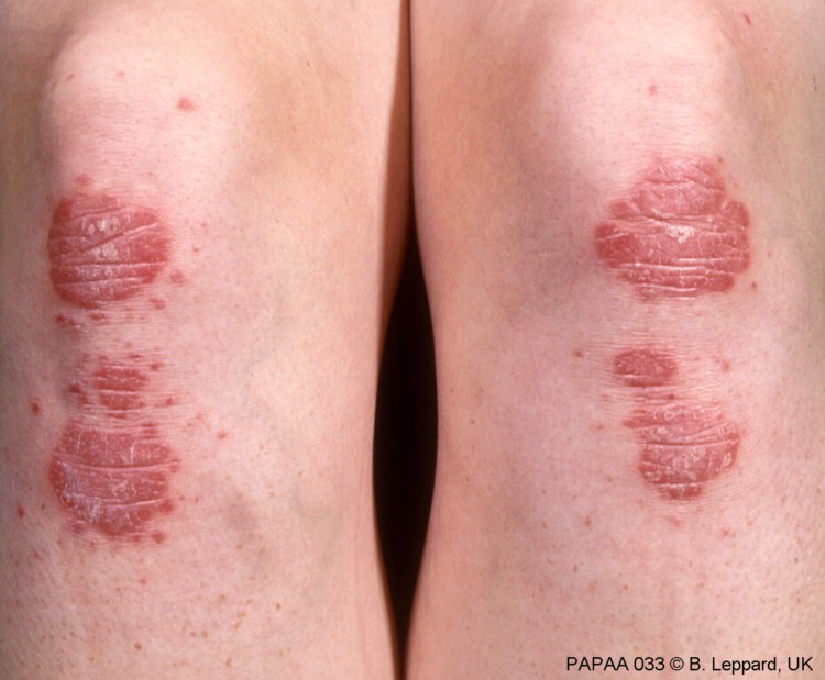 Plaque psoriasis on knees and lower leg.jpg