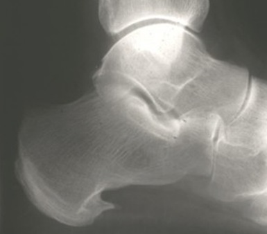 What is psoriatic arthritis.jpg