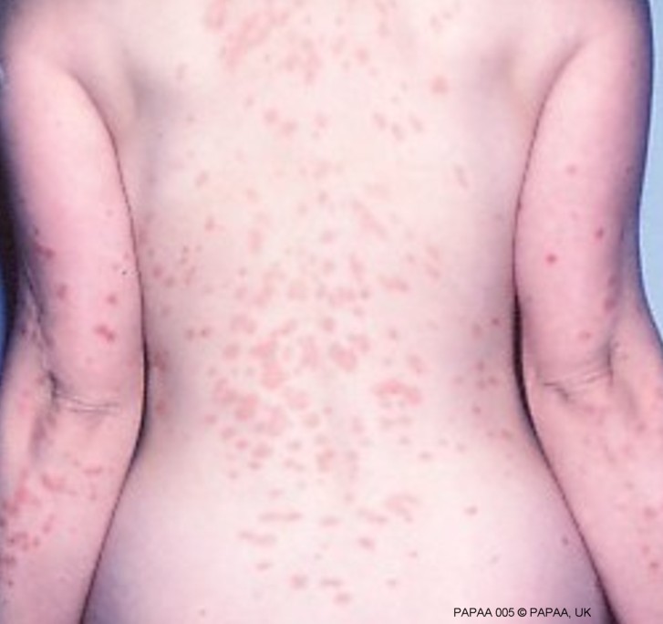 Guttate psoriasis on female back.jpg