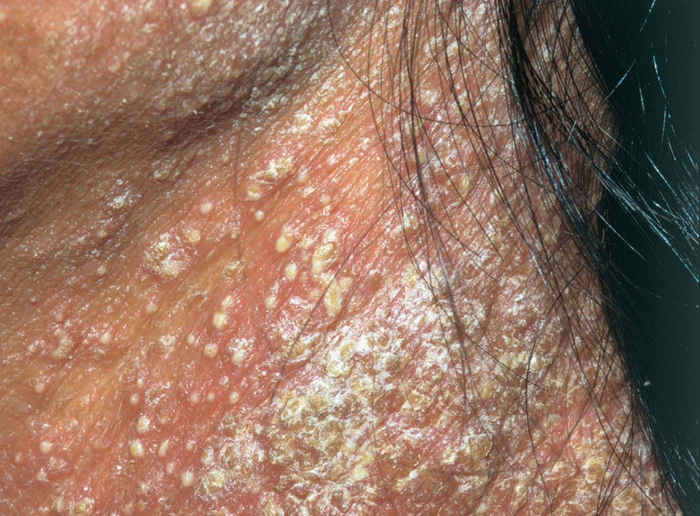 Generalised pustular psoriasis on neck.jpg