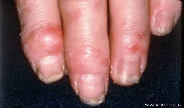 Psoriatic arthritis fingers 2.jpg