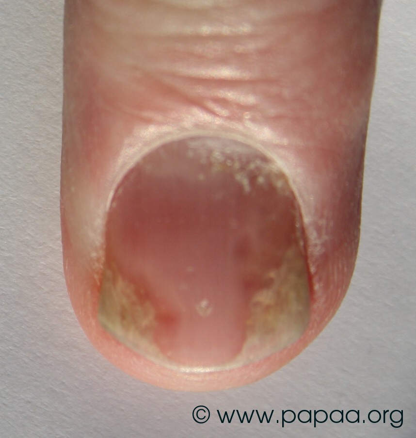 Nail psoriasis 8.jpg